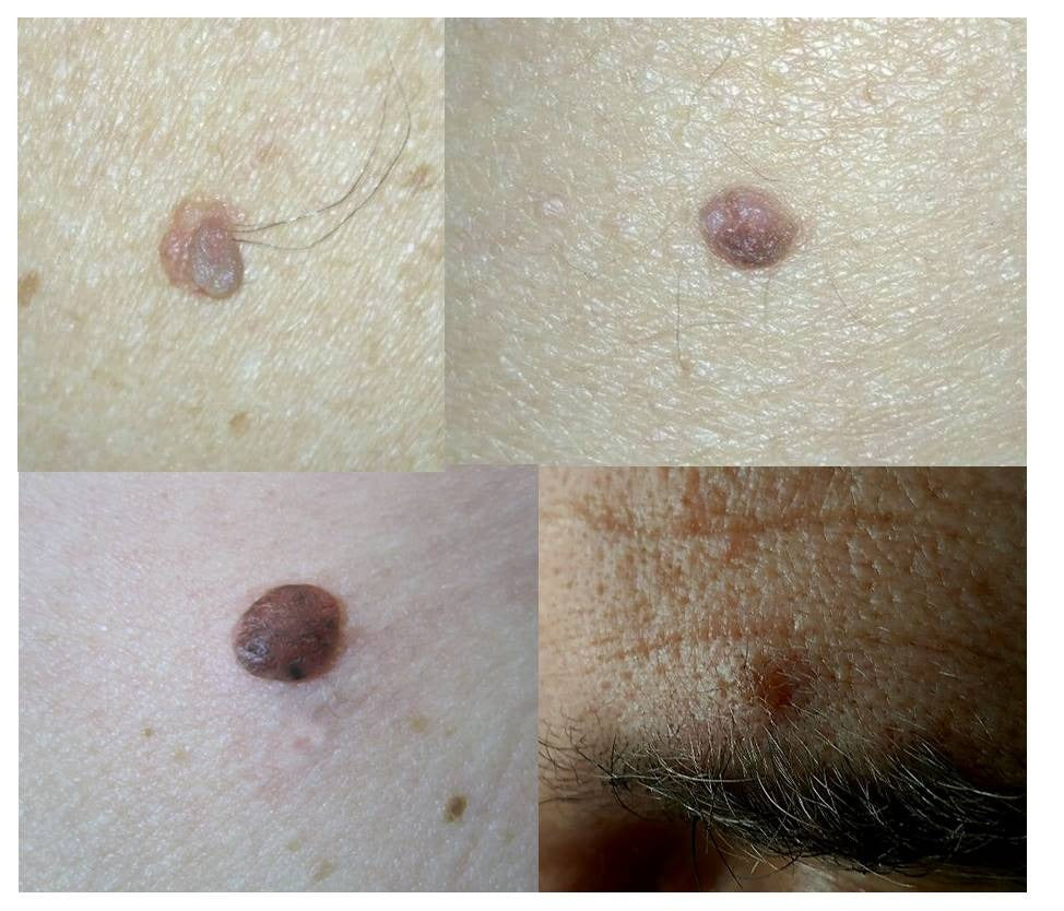 SkinTag™ Removedor de Verrugas y Lunares (Pack x120 und) |
